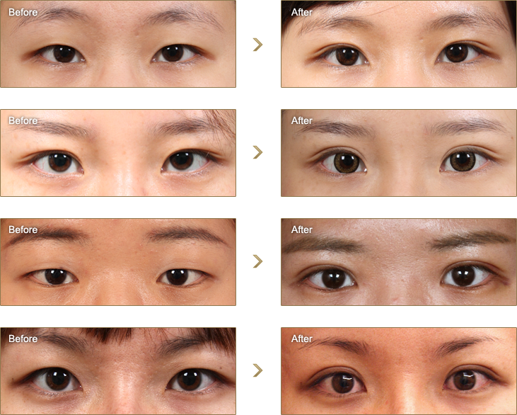 韩式钉书机双眼皮和韩式三点定位双眼皮是一回事吗？