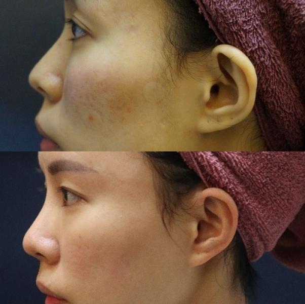 韩式隆鼻和硅胶隆鼻自体肋骨隆鼻有什么优点？鼻型雕塑术后注意事项
