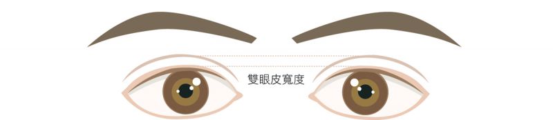 双眼皮整形手术韩式埋线切开全切双眼皮分别适合哪些症状哪些人？