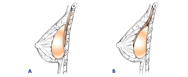 隆胸的几种手术方式简介：肚脐隆胸 腋下隆胸乳晕隆胸哪种好？