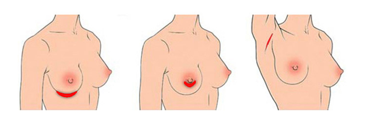 果冻隆胸植入切口在哪里？隆胸注意事项有哪些？