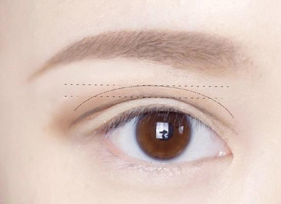 双眼皮手术多久看起来才会比较自然？双眼皮两边出现不对称该怎么办呢？
