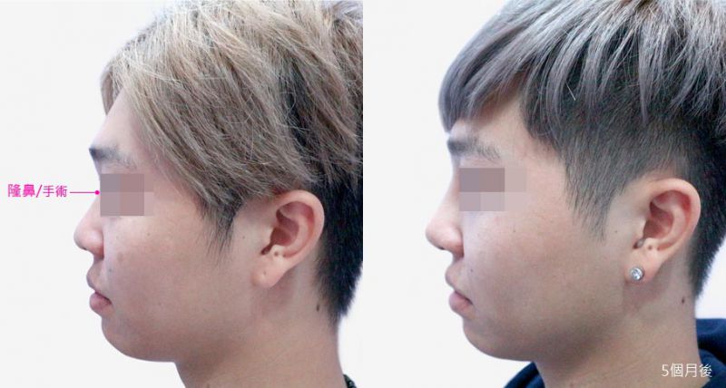 韩式两段式隆鼻手术是最好的吗？隆鼻的适应人群和禁忌人群有哪些？