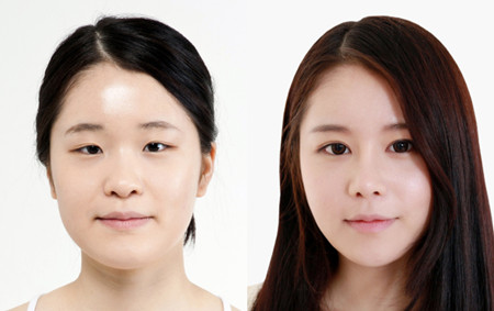 肋软骨隆鼻会有什么副作用吗？韩式隆鼻手术与传统隆鼻之比较