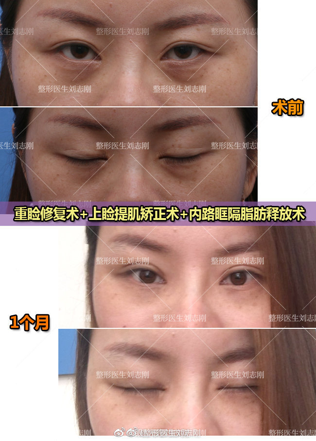 眼部修复整形刘志刚技术怎么样？刘志刚双眼皮修复预约多少钱？