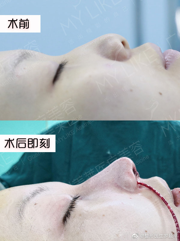 中国最有名的隆鼻整形医生有哪些？中国知名鼻综合医生排行榜