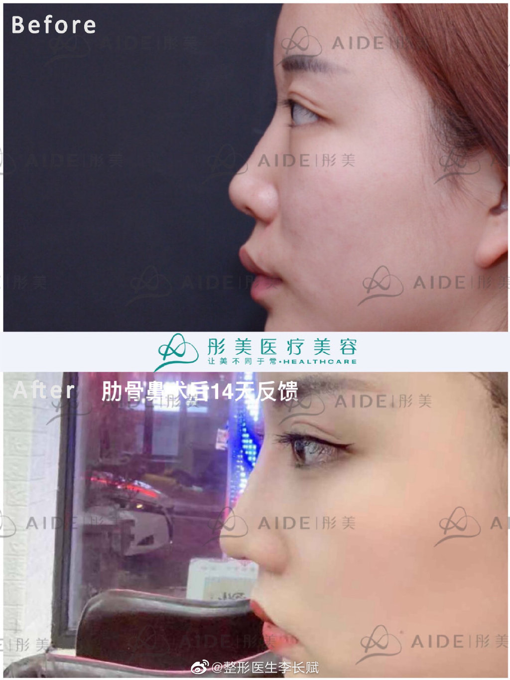 分享微驼峰鼻子模版鼻综合手术 🧐🧐最近很多姐_圈子-新氧美容整形