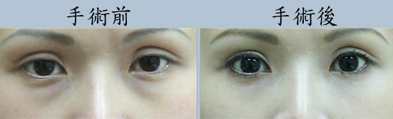 无疤眼袋脂肪移位手术效果怎么样？深入了解无疤眼袋脂肪移位方式