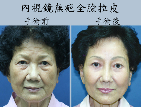 额头老化中脸老化面部肌肤下垂怎么办？面部老化及治疗简介
