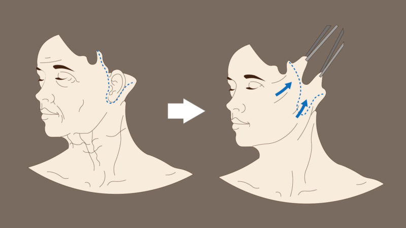 中下脸拉皮手术是在耳垂后面吗？中下脸拉皮手术注意事项有哪些？