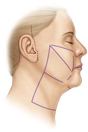 脸部老化下垂的原因是什么？怎么治疗？面部拉皮手术能维持多久？