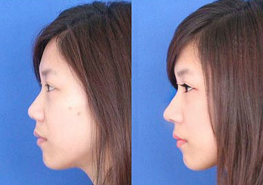 卡麦拉隆鼻和韩式隆鼻应该怎么选？哪个隆鼻效果好？