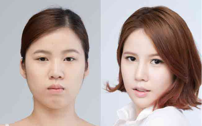 韩式隆鼻中鼻部哪些部位可以用自体软骨？鼻背鼻根鼻中隔