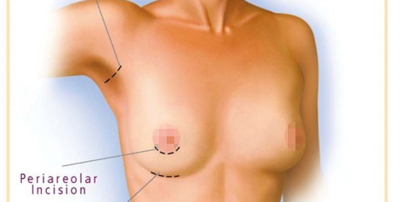 内视镜隆胸手术切口和硅胶隆胸假体位置在哪里？