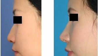 韩式隆鼻就是二段式隆鼻吗？韩式隆鼻与一般隆鼻手术有何不同？