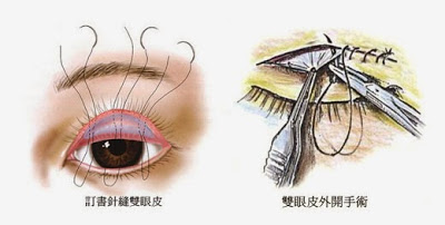 眼部美容手术有哪几种？双眼皮手术祛眼袋手术拉皮手术