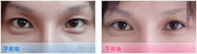 精雕韩式极致双眼皮手术方式适合对象注意事项有哪些？