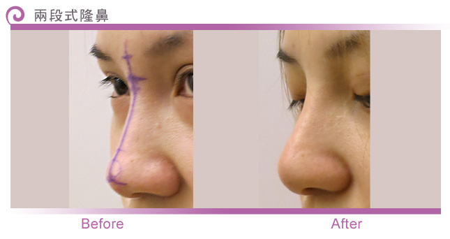 什么是两段式隆鼻？两段式隆鼻术前术后注意事项有哪些？