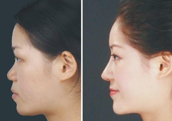 一段式隆鼻两段式隆鼻敲鼻骨缩鼻翼恢复期都分别是多少？