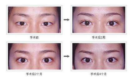 眼皮过于下垂眼皮脂肪肥厚可以做双眼皮吗？双眼皮术前术后注意