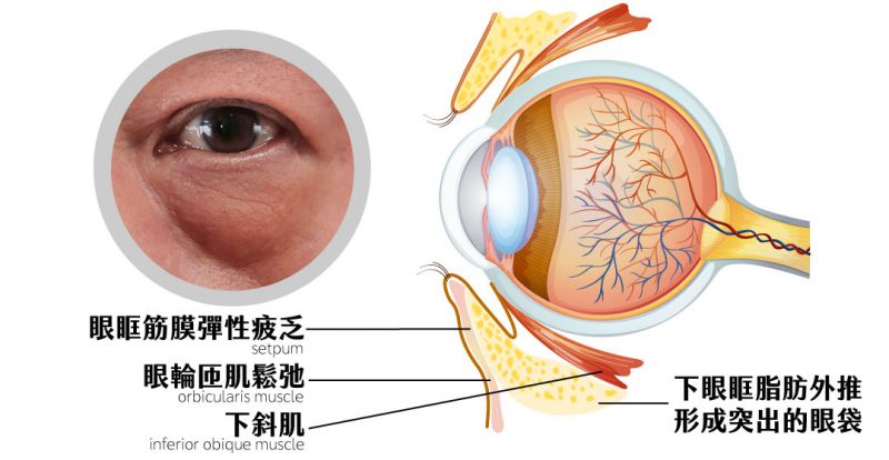 无痕祛眼袋手术步骤是怎么样的？隐痕眼袋适用对象有哪些？