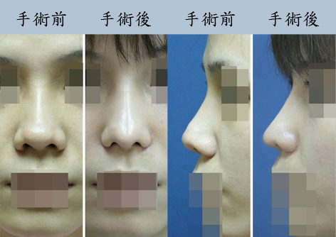 比两段式韩式隆鼻更好的隆鼻手术方式是什么？镶钻式精致鼻雕