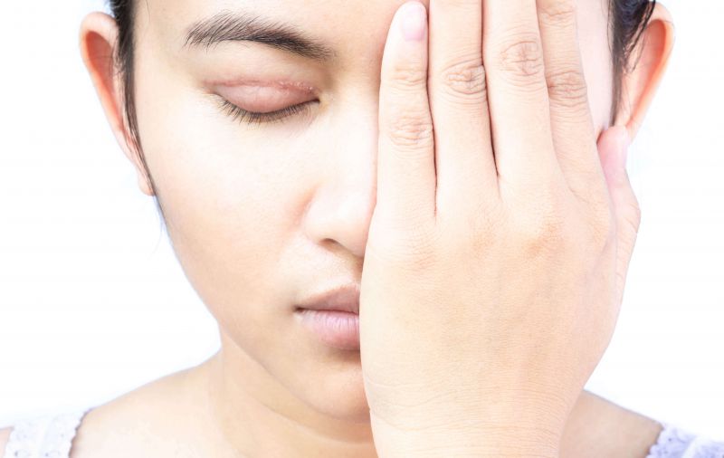 双眼皮术后怎么防止疤痕产生？双眼皮术后注意事项有哪些？