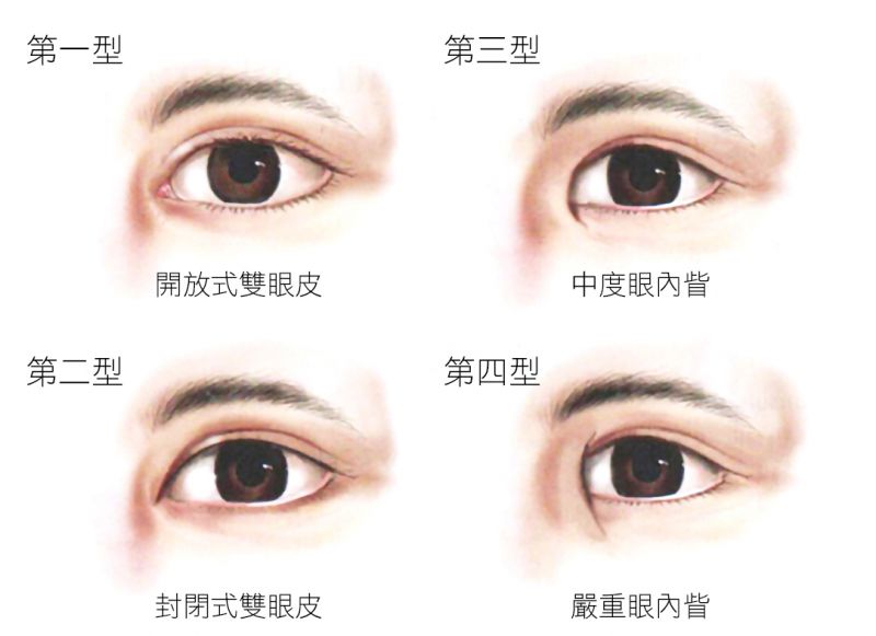 电眼韩式双眼皮需要住院吗？电眼韩式双眼皮伤口和恢复期多久？