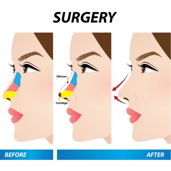 植入式隆鼻手术有哪些？什么是一段式隆鼻二段式隆鼻三段式隆鼻？