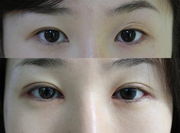 上眼皮手术后不对称该如何改善？有哪些注意事项？