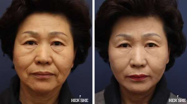 上海九院脸部拉皮手术哪个医生做的好？