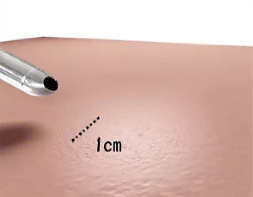 自体脂肪丰胸采用水刀抽脂手术流程是怎样的？