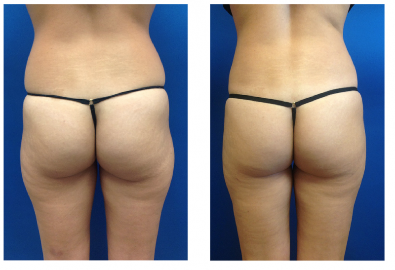 身体结构导致不同类型的屁股形状？臀型分类详解