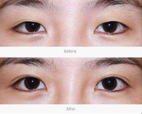 什么是三点式双眼皮手术？韩式三点式双眼皮优点有哪些？