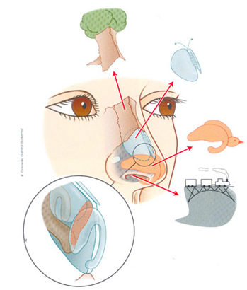 PureFormGoreTex鼻植入物隆鼻有哪些优点？