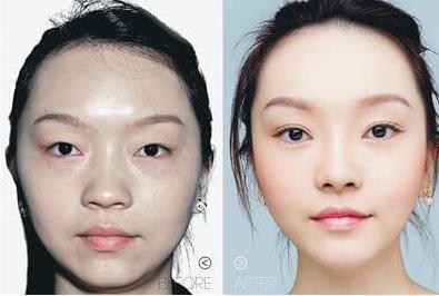 韩式三点式双眼皮手术有哪些并发症和后遗症？