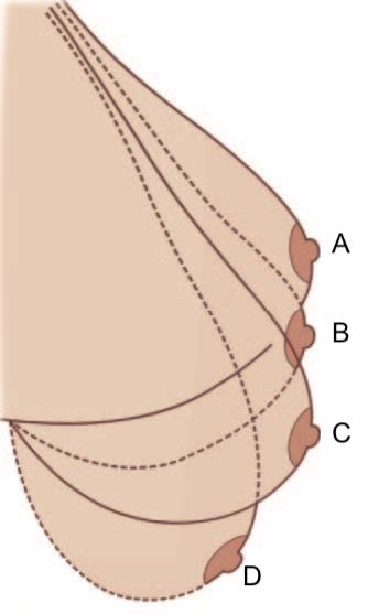 乳房下垂的严重程度怎么区别？提乳合并隆胸手术效果好吗？
