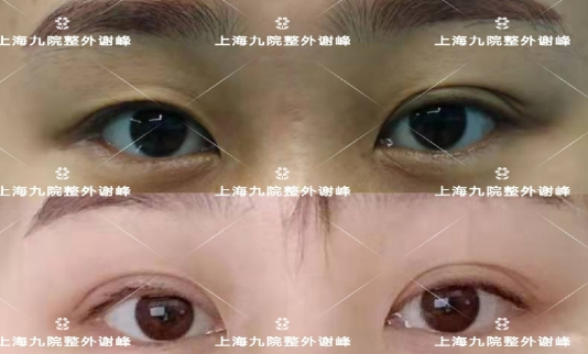 上海九院谁双眼皮修复做得好？上海修复双眼皮前七名预约排行榜