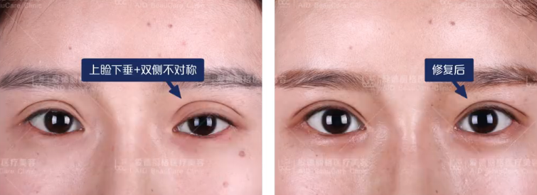 中国双眼皮修复专家排名是怎样的？修复双眼皮谁最厉害？