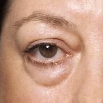 卧蚕泪沟黑眼圈会变成眼袋吗？祛眼袋手术方式有哪些？