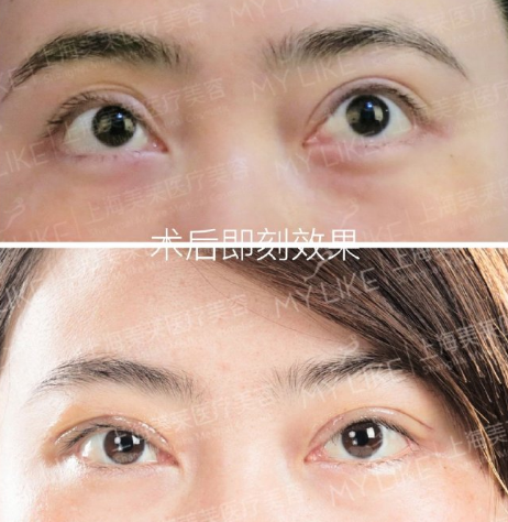 杜园园和刘志刚哪个医生技术好？刘志刚和杜园园修复双眼皮案例对比预约