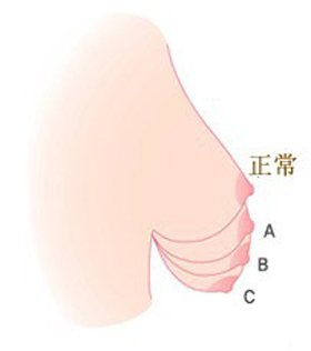 胸部下垂怎么自测？胸部下垂提升的手术方法简介