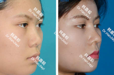 上海哪个医生做鼻子好？上海预约最多知名鼻子专家排行榜