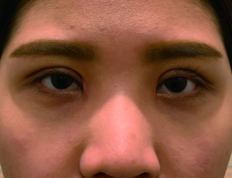割的双眼皮和缝的双眼皮有什么不同？双眼皮后多久需要化妆？