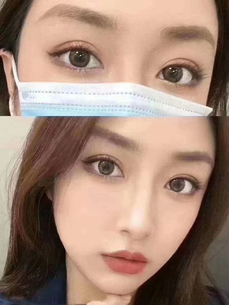 郑州哪个医生做双眼皮手术最好？