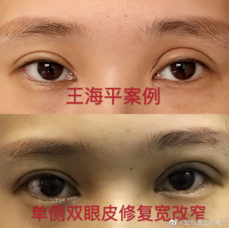 武汉专门修复双眼皮专家哪个最好？