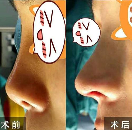 2020年中国鼻修复专家排名 2020年国内最好的隆鼻修复医生预约