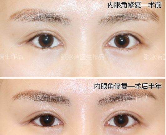 北京做双眼皮修复哪些医生厉害？