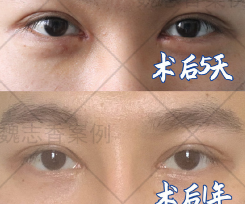 魏志香和王世勇谁做双眼皮修复好？