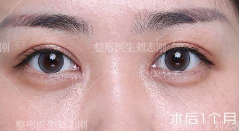 国内修复双眼皮权威专家排名 眼修复权威医生预约排名